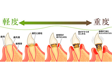 治療内容_歯周病