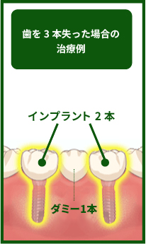 case2-歯を3本失った場合-img