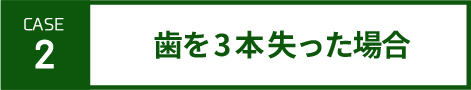 case2-歯を3本失った場合-SP