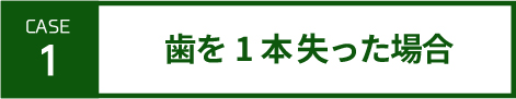 case1-歯を一本失った場合-SP