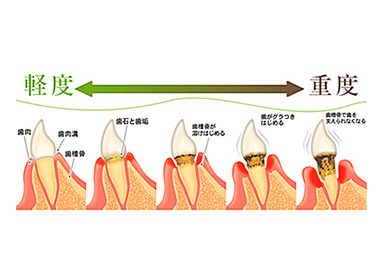 slide9-歯周病-2
